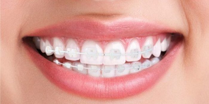 What are the most aesthetic orthodontic treatments