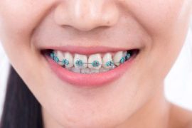 SOFT FOODS TO EAT WITH BRACES