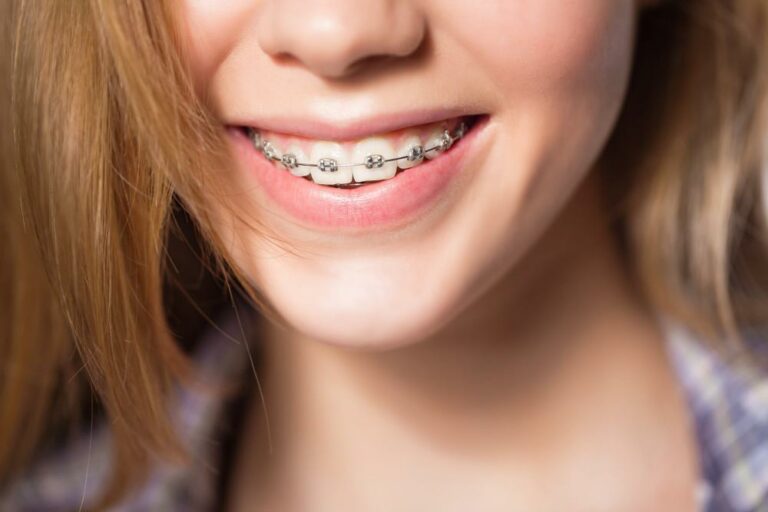 🥇 Cuanto Cuesta Ponerse Brackets【2021】En Estados Unidos, todo aqui