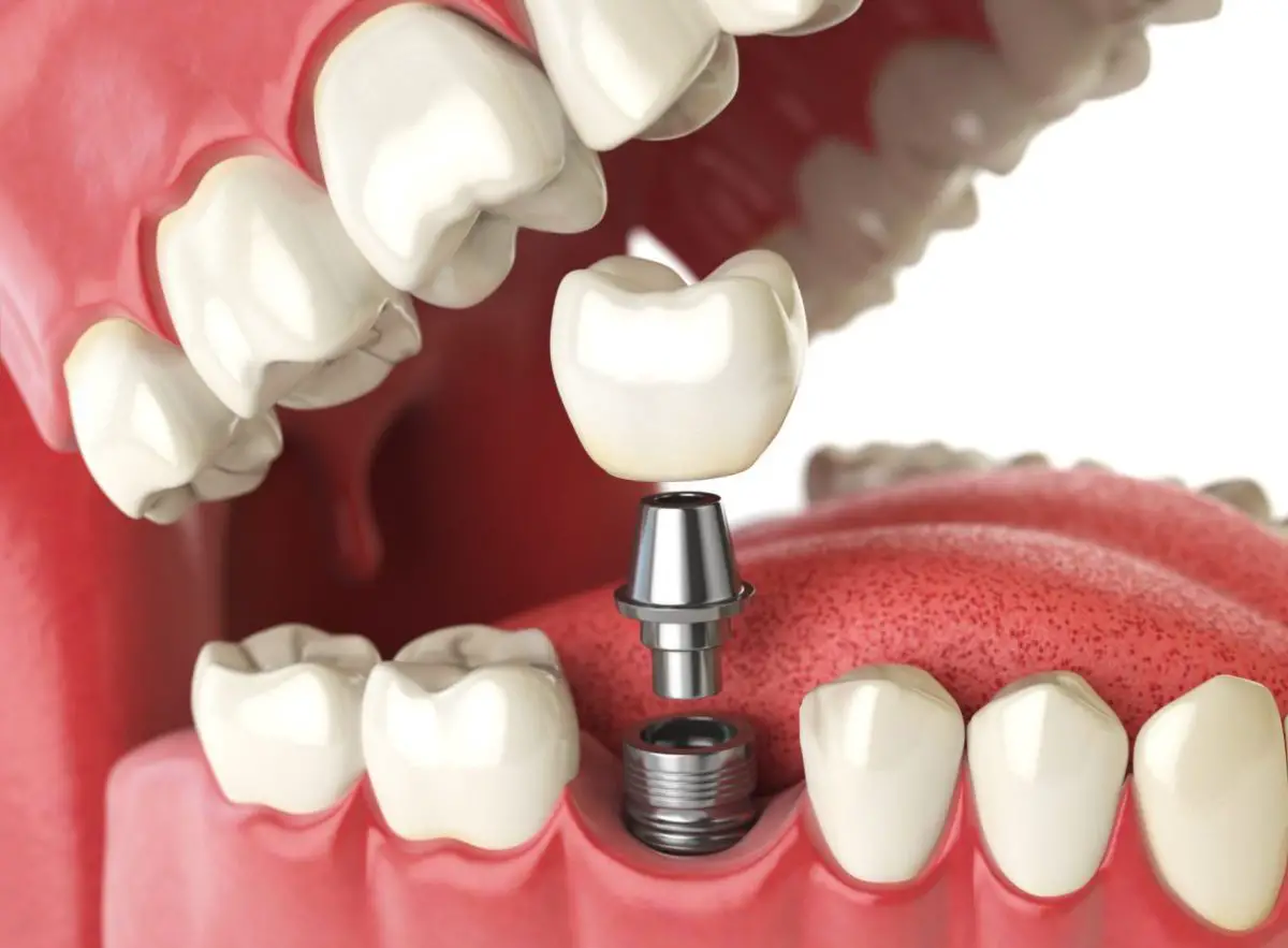 Cuanto Cuesta Un Implante Dental En Estados Unidos?