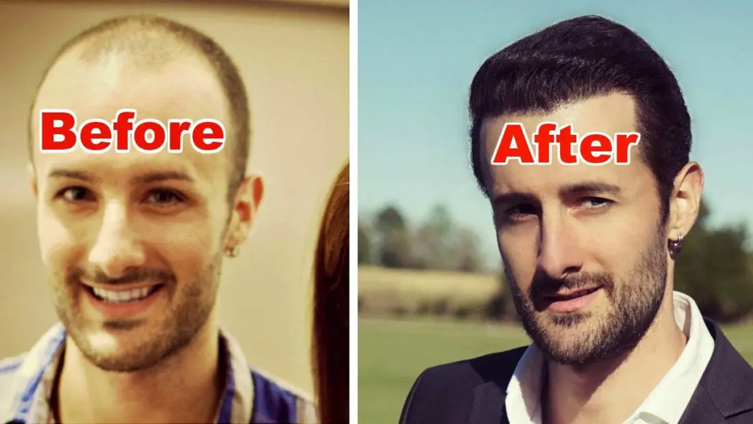 ¿Cuanto cuesta un transplante de cabello en Estados Unidos?