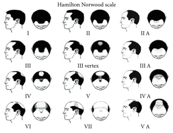 Hombres con pérdida de cabello Norwood Etapa 3 y superior