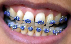 braces-elastics-purple-300x187-7881086