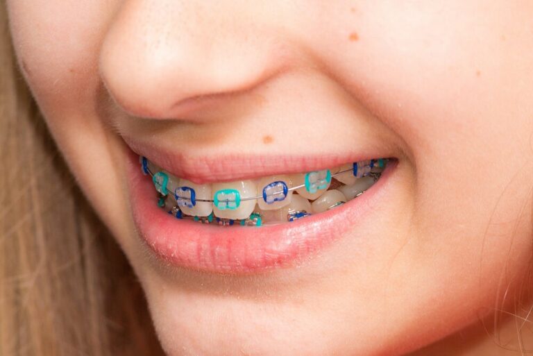 Choose The Best Colors For Your Braces【 2021 】good Colors And Ideas 