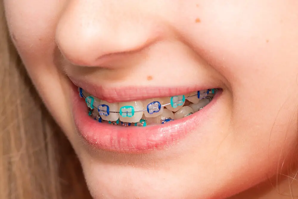 Colors Of Children’s Braces