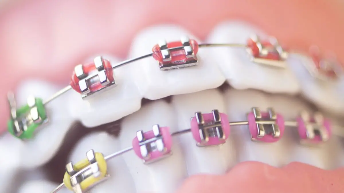 Choose The Best Colors For Your Braces | What color should I get?