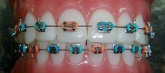 blue and orange braces