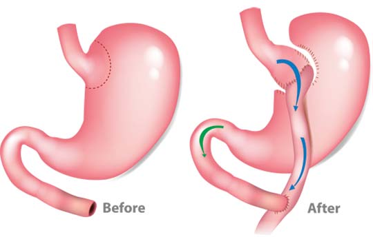 Gastric bypass