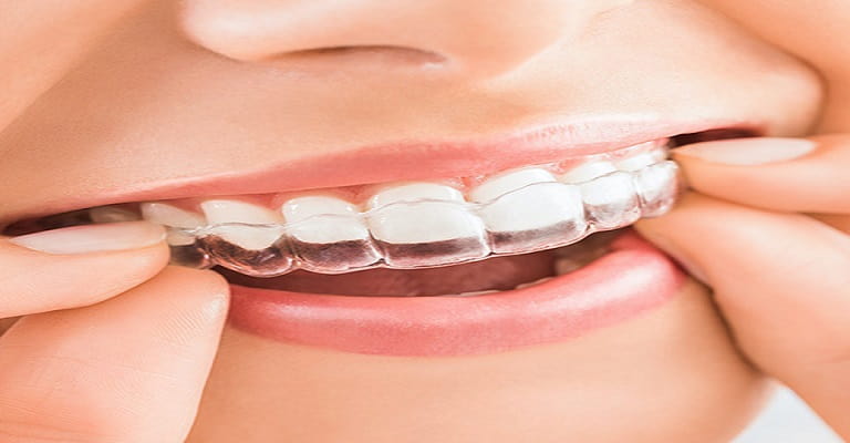 What Is The Best Alternative To Braces For Adults